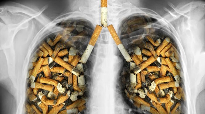 lung cancer